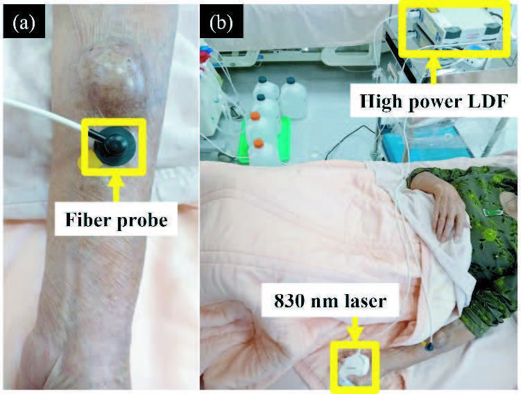 LDF 探頭與 830nm PBM 照射示意